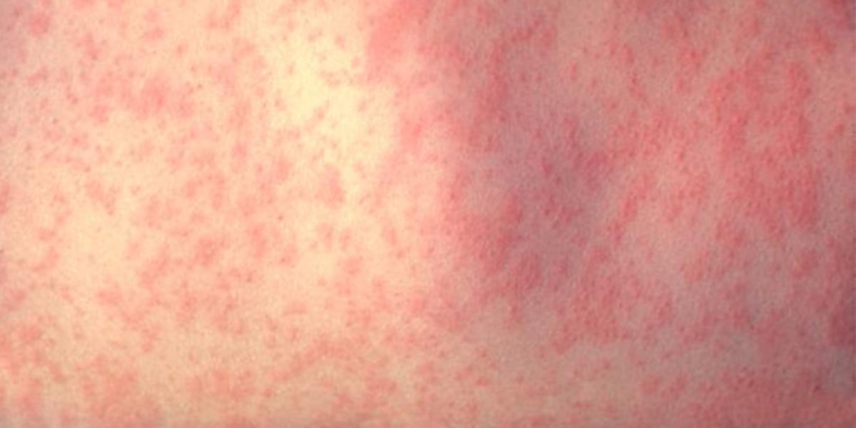 Photo: kjct8.com Colorado Measles Exposure Sites Released After Traveler Tests Positive